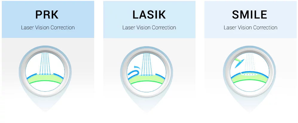 فمتو اسمایل بهترین روش برای جراحی عیوب انکساری است 1 lasik prk smile.png